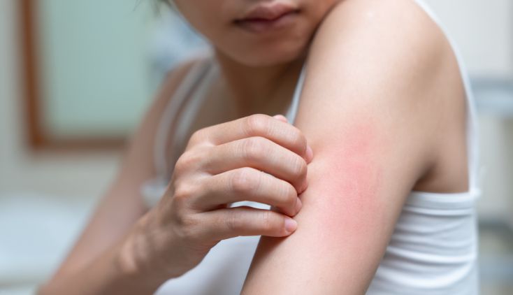A woman in a white tank top scratching a red rash on her arm.