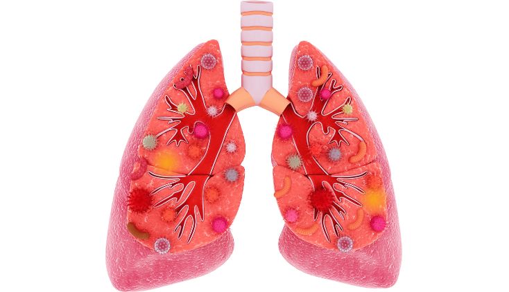 A drawing of lungs full of bacteria and germs.
