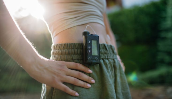 A woman wearing an insulin pump.